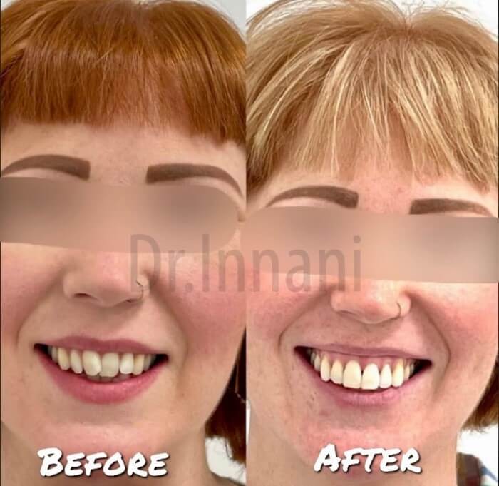 Before and After Cosmetic Dental Bonding in Aldersbrook East London