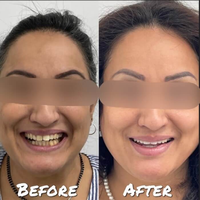 Asian Lady Showing Smile Before and After Having Dental Bonding in East London