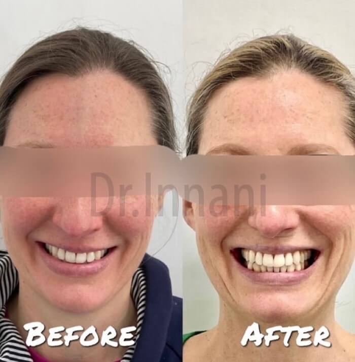 Cosmetic Dental Bonding Before and After Makeover Dental Bonding in East London