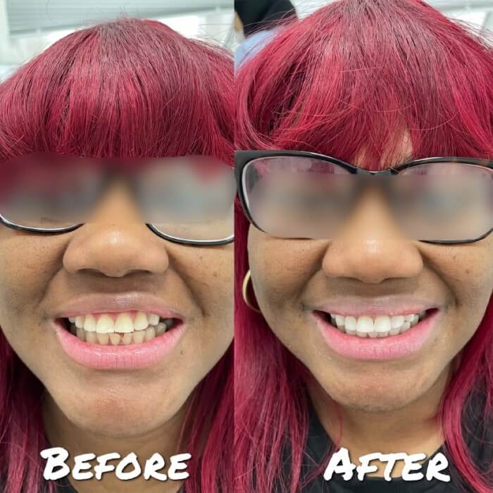 Youn Black Lady Before and After Having Dental Bonding