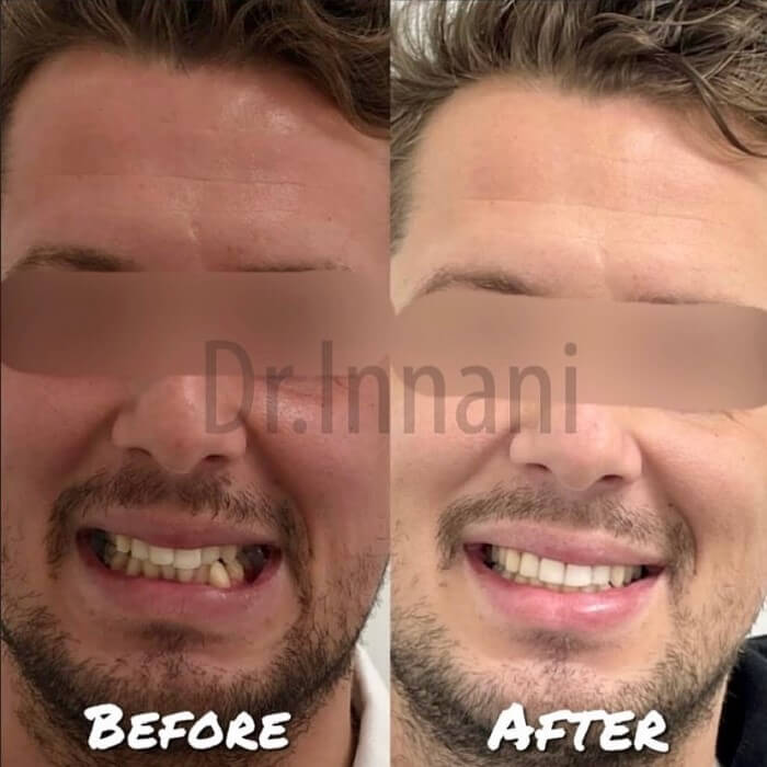 Man Showing Smile Before and After Composite Bonding Dental Makeover