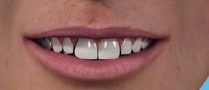 The Mother Of One Undergoing A Teeth Whitening Treatment At Home In Essex